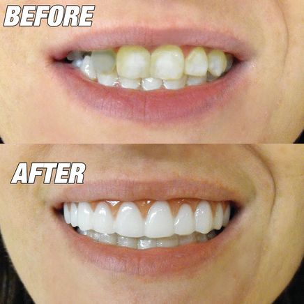 Instant Smile™ Comfort Fit Flex Upper Veneer Bright White-366589