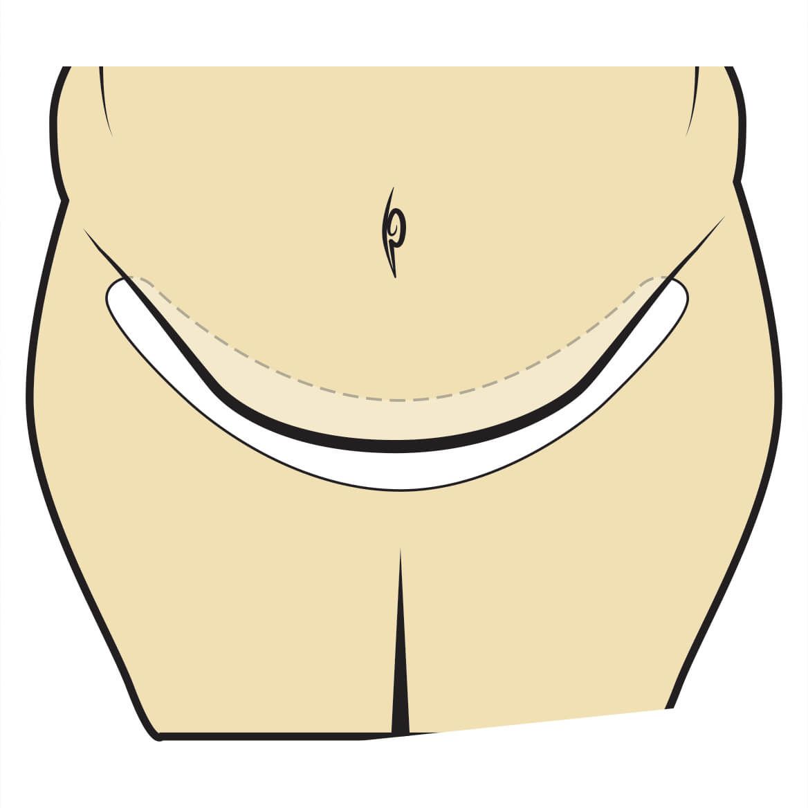 Tummy Liners Set of 3-341619