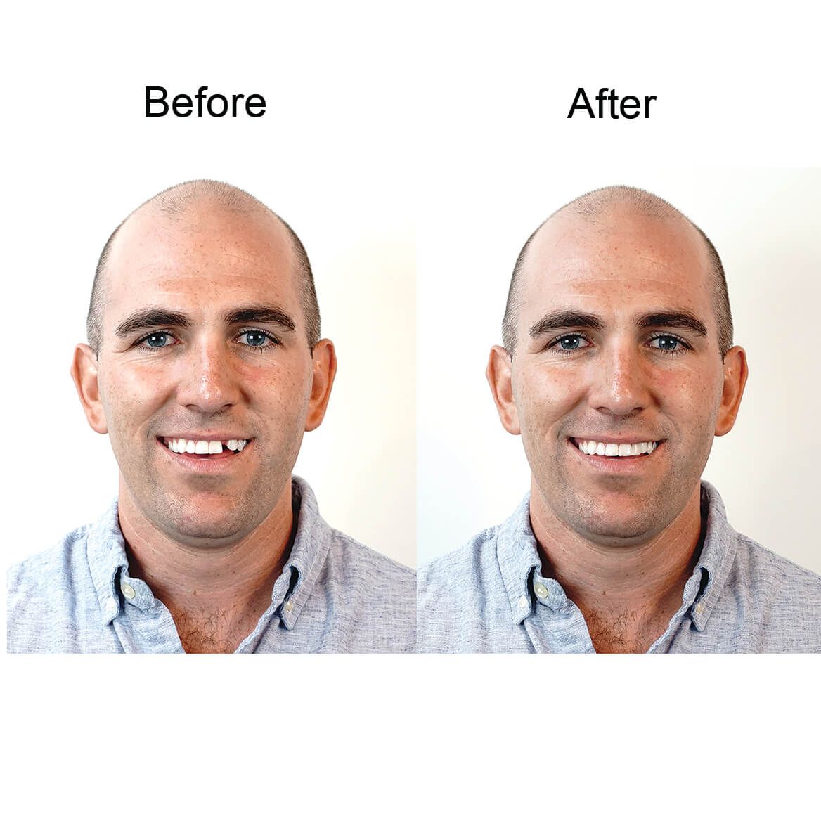 Instant Smile™ Temporary Tooth Replacement Kit-366588