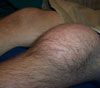 A hairy knee with bursitis