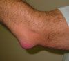 An elbow with bursitis