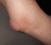 A knee with bursitis
