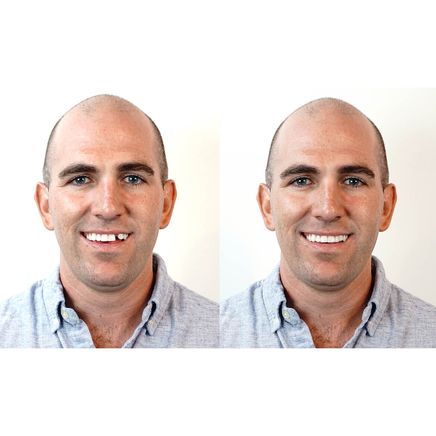 Instant Smile™ Complete Your Smile™ Tooth Replacement Kit-371589